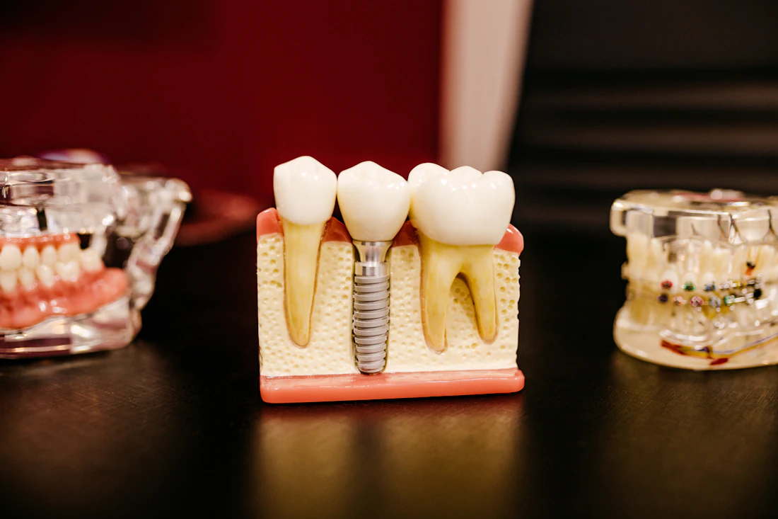 Modelo de implante dentário entre dentes